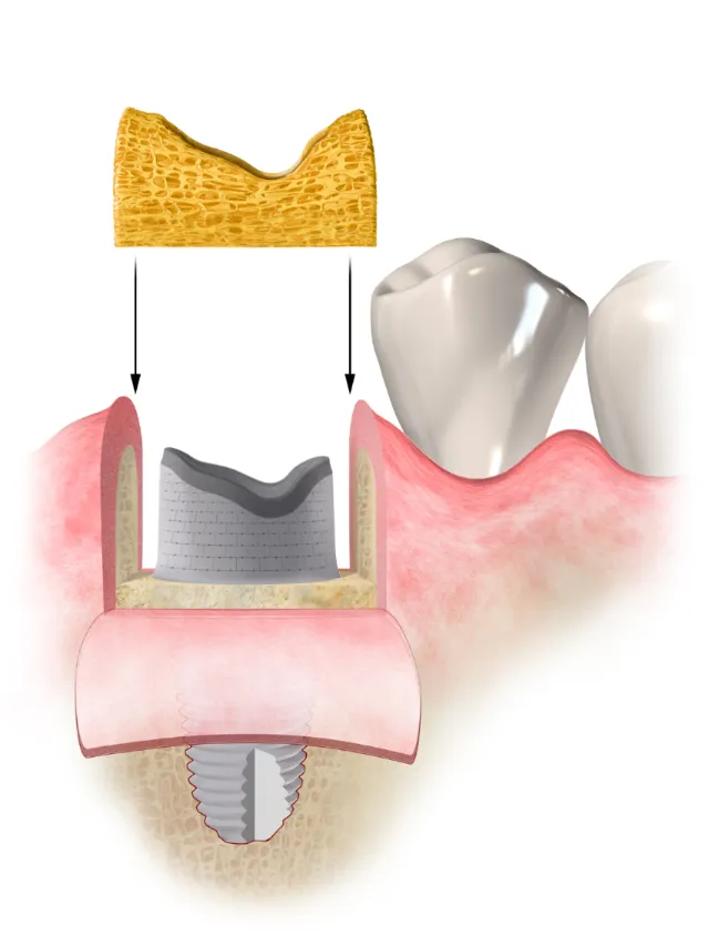 Medical illustration of dental procedure
