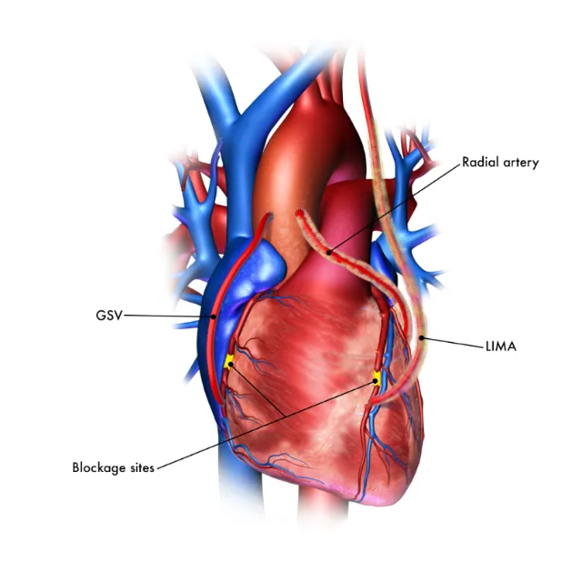 Medical illustration of coronary bypass with labeled arteries by Craig Foster
