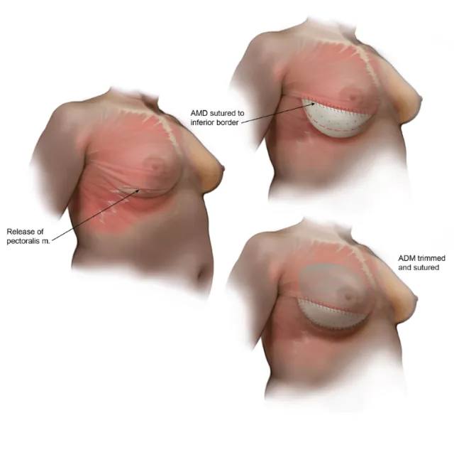 Medical illustration of pectoralis muscle release and ADM placement by Alex Webber