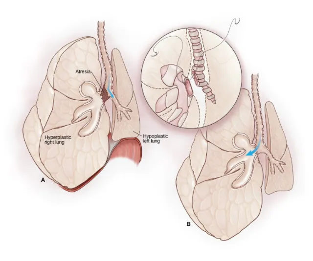 Medical diagram showing hypoplastic and hyperplastic lungs with atresia by Alex Webber
