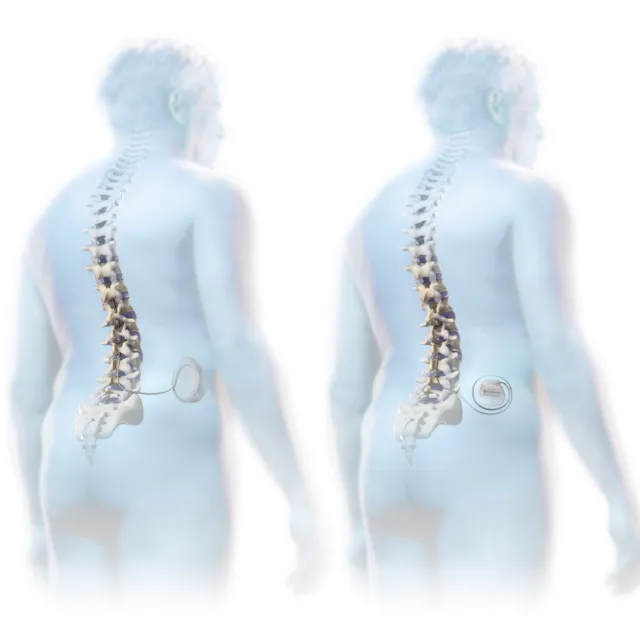 An illustration of implantable medical devices