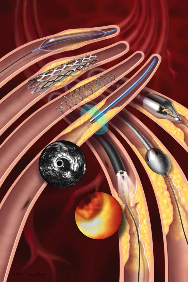 Endovascular stents and catheters inside blood vessels by Craig Foster