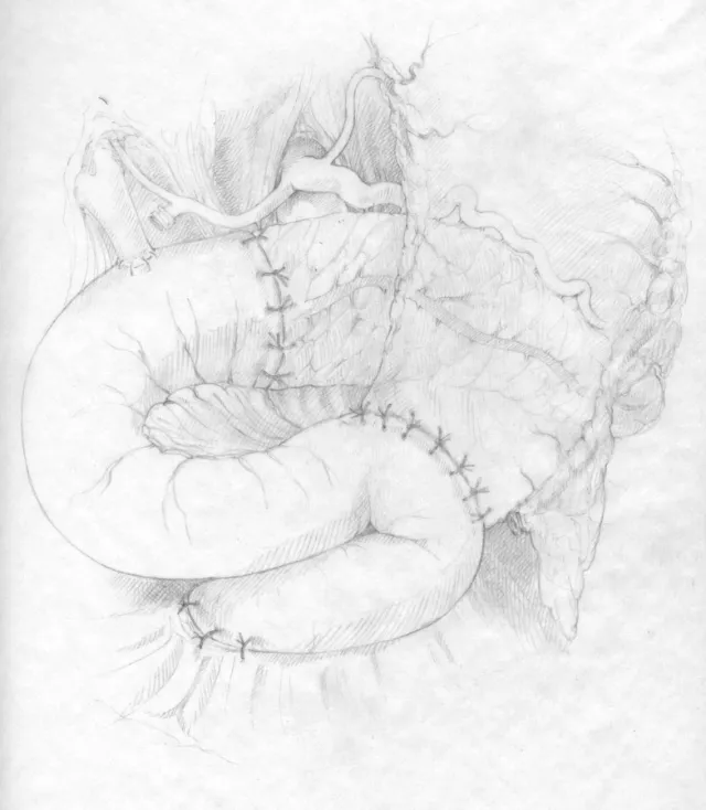 An illustration sketch of Whipple procedure