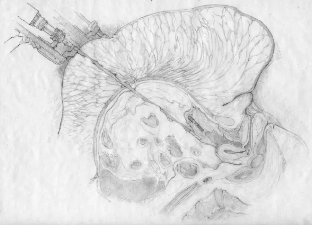 An illustration sketch of surgery with morbid obesity