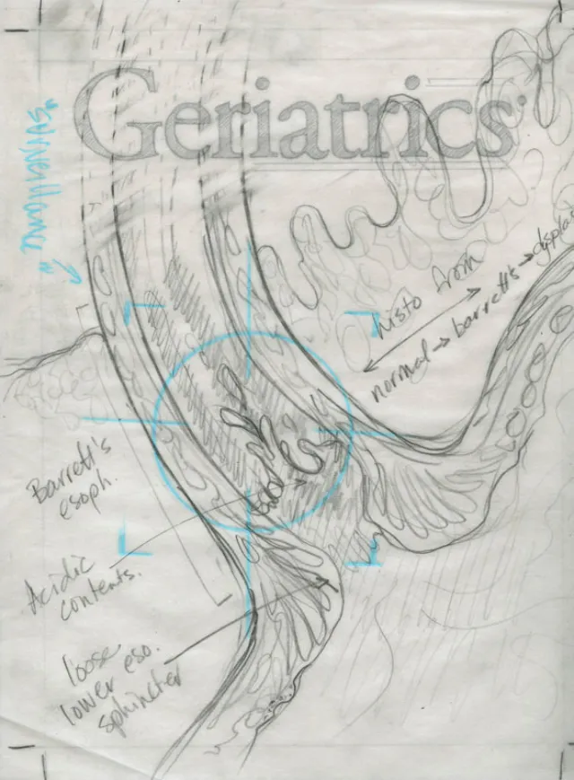 An illustration of Barrett's esophagus