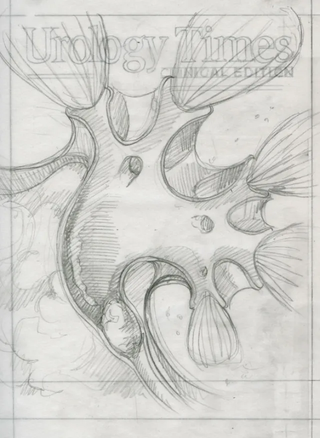 kidney stone - Medical illustration collection