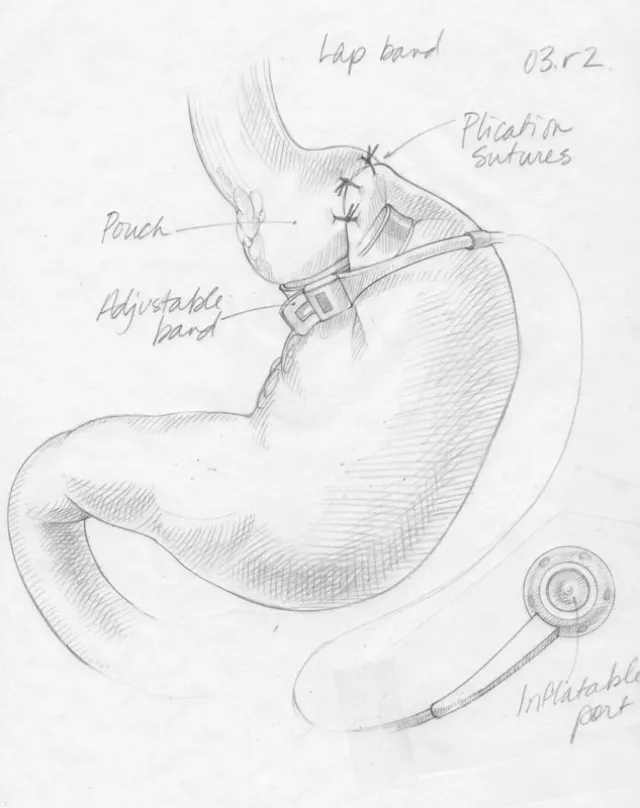 Medical illustration - Sketch for bariatric surgery comparison