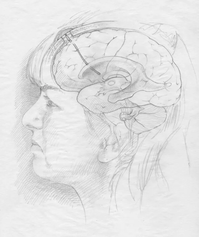 An illustration sketch of brain stent for delivery of chemotherapy