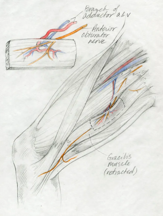 Medical illustration - Gracilis muscle flap