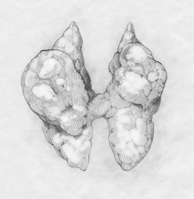 Thyroid cancer - Medical illustration collection