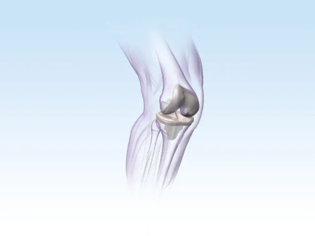 An illustration of KNEE implant hr