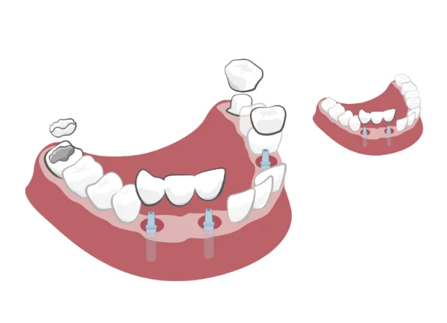 Illustration of dental implants and dentures for missing teeth by Andreas Schickert